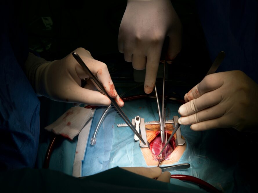 Aortic Aneurysm Surgery A Clear Guide to Treatment, Risks, and Recovery