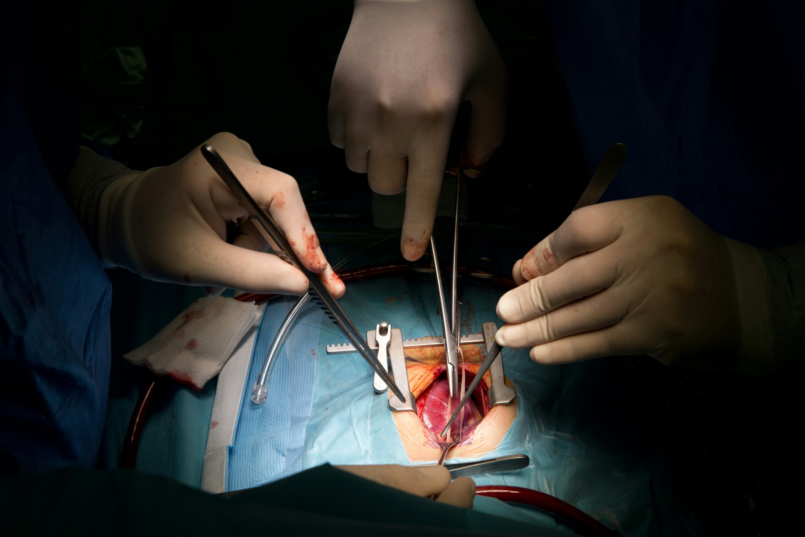 Aortic Aneurysm Surgery A Clear Guide to Treatment, Risks, and Recovery